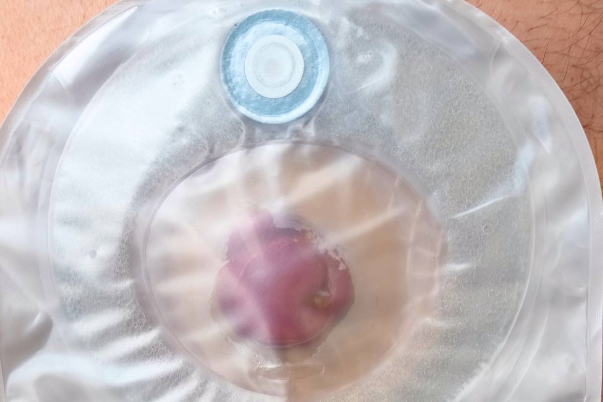 ostomy bag and stoma