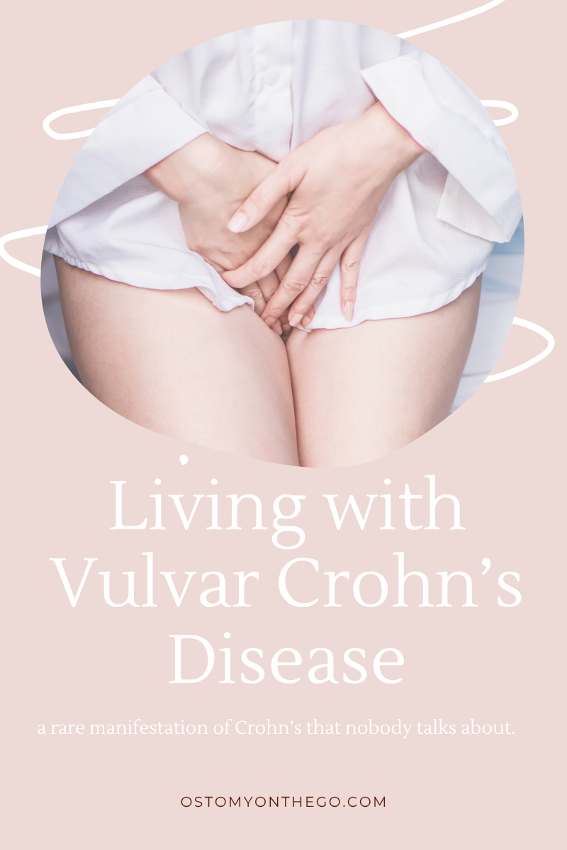 Vulvar Crohn’s disease 